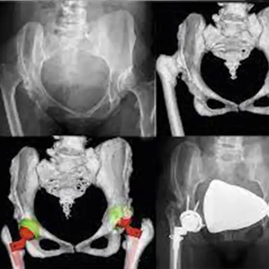 3D CT Hip Joint